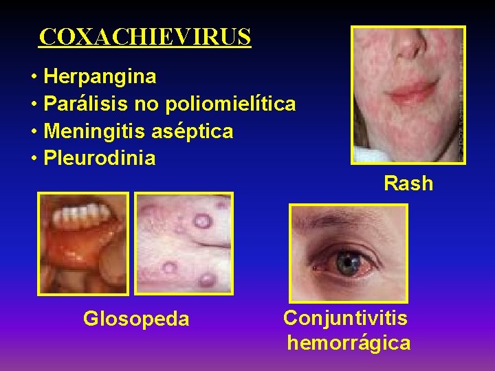 COXACHIEVIRUS • Herpangina • Parálisis no poliomielítica • Meningitis aséptica • Pleurodinia Rash Glosopeda