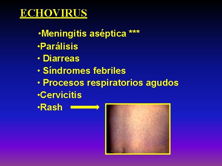 ECHOVIRUS • Meningitis aséptica *** • Parálisis • Diarreas • Síndromes febriles • Procesos