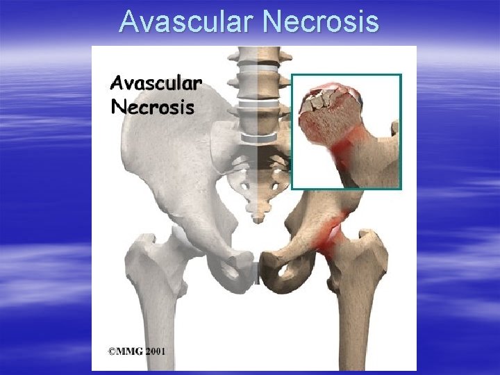 Avascular Necrosis 