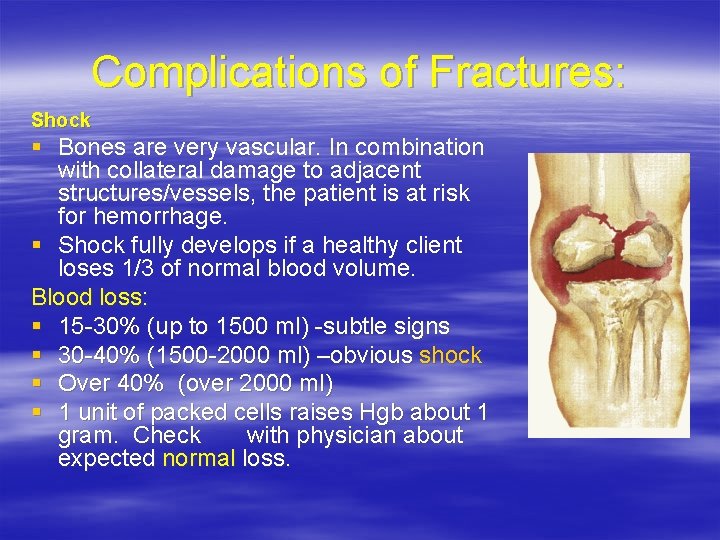 Complications of Fractures: Shock § Bones are very vascular. In combination with collateral damage
