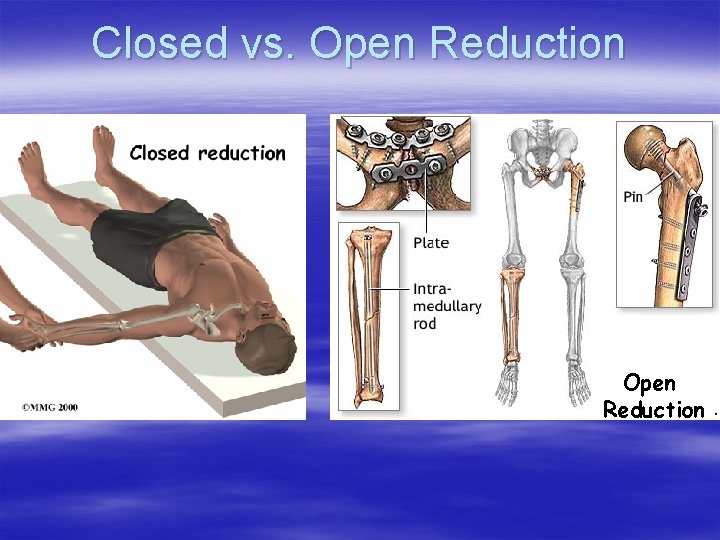 Closed vs. Open Reduction 