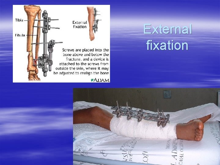 External fixation 