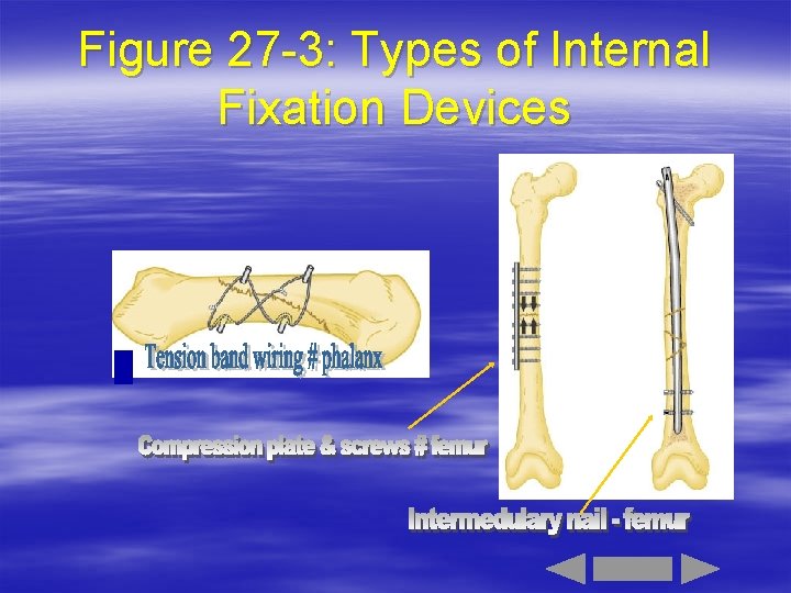 Figure 27 -3: Types of Internal Fixation Devices 