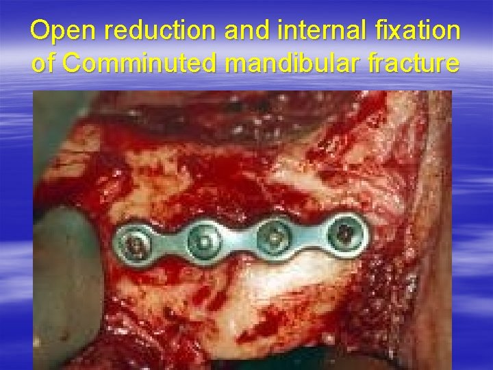 Open reduction and internal fixation of Comminuted mandibular fracture 