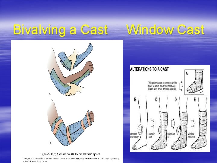 Bivalving a Cast Window Cast 