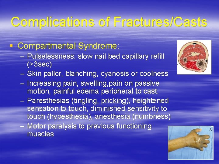 Complications of Fractures/Casts § Compartmental Syndrome: – Pulselessness: slow nail bed capillary refill (>3