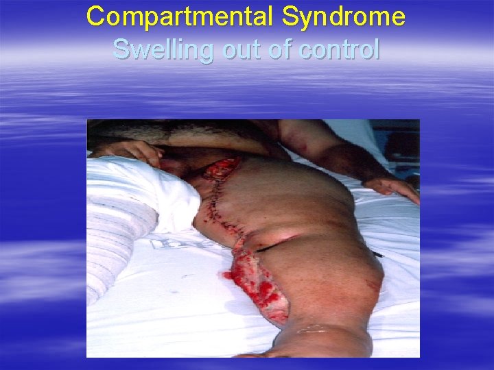 Compartmental Syndrome Swelling out of control 