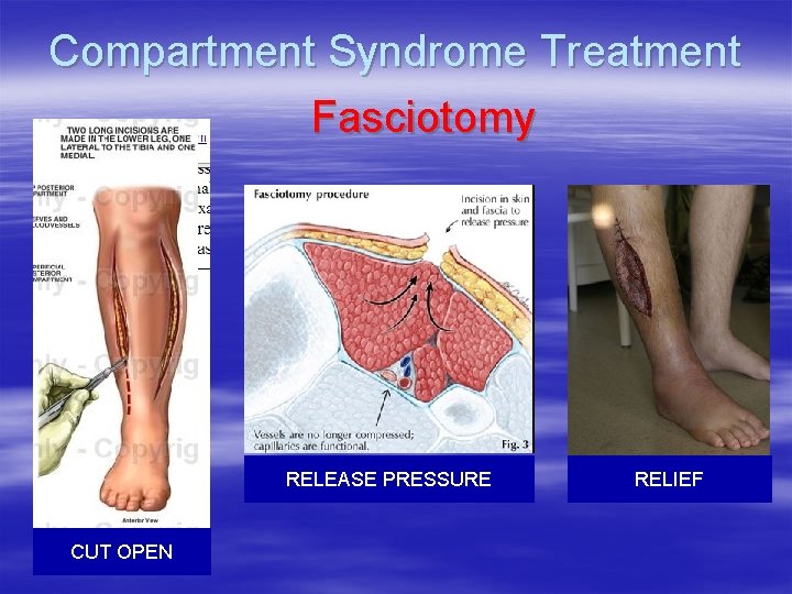 Compartment Syndrome Treatment Fasciotomy RELEASE PRESSURE CUT OPEN RELIEF 
