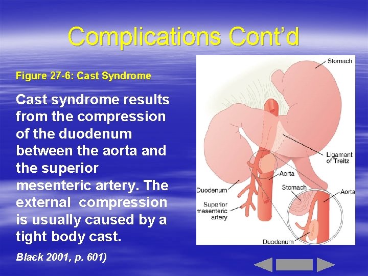 Complications Cont’d Figure 27 -6: Cast Syndrome Cast syndrome results from the compression of