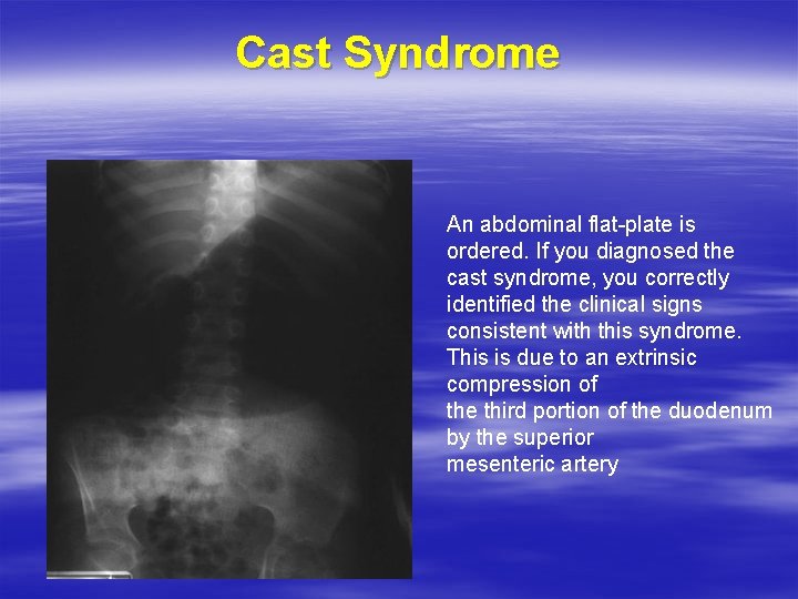 Cast Syndrome An abdominal flat-plate is ordered. If you diagnosed the cast syndrome, you