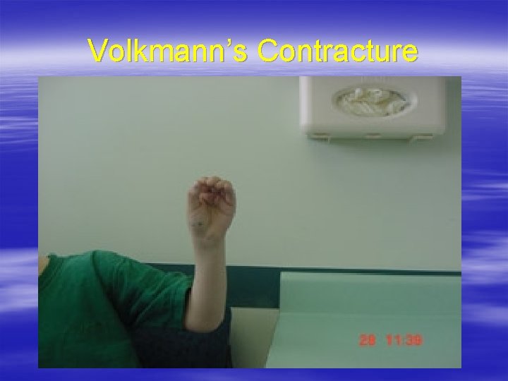 Volkmann’s Contracture 