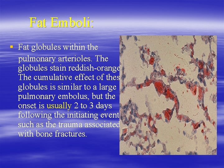 Fat Emboli: § Fat globules within the pulmonary arterioles. The globules stain reddish-orange. The