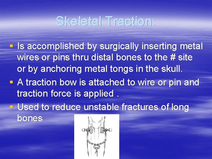 Skeletal Traction: § Is accomplished by surgically inserting metal wires or pins thru distal