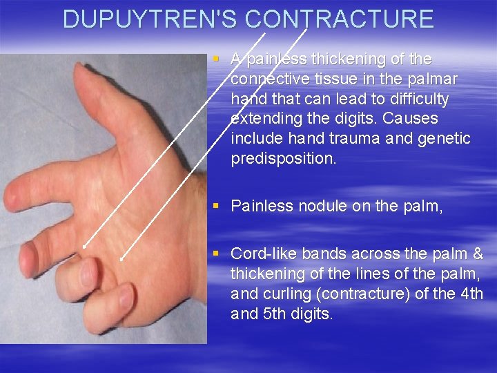 DUPUYTREN'S CONTRACTURE § A painless thickening of the connective tissue in the palmar hand