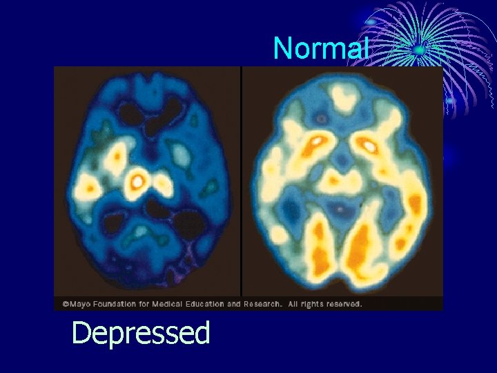 Normal Depressed 