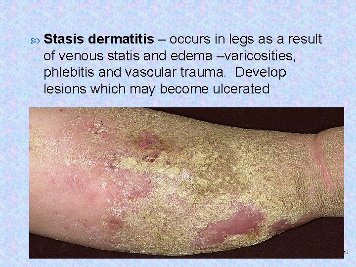  Stasis dermatitis – occurs in legs as a result of venous statis and