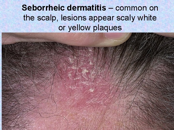 Seborrheic dermatitis – common on the scalp, lesions appear scaly white or yellow plaques