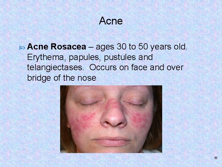 Acne Rosacea – ages 30 to 50 years old. Erythema, papules, pustules and telangiectases.