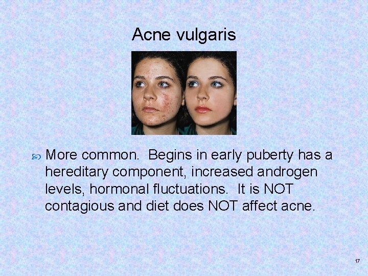 Acne vulgaris More common. Begins in early puberty has a hereditary component, increased androgen