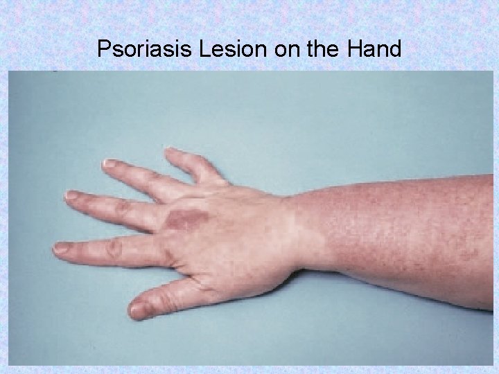 Psoriasis Lesion on the Hand From Ignatavicius DD, Workman ML: Medical-surgical nursing: patient-centered collaborative