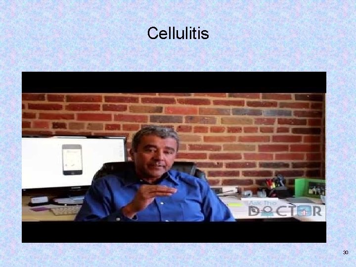 Cellulitis 30 