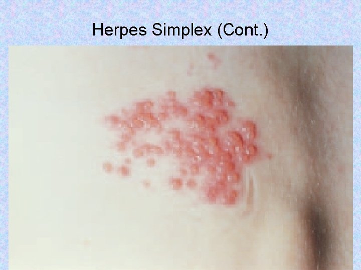 Herpes Simplex (Cont. ) Copyright © 2017, Elsevier Inc. All rights reserved. 35 