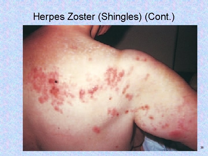 Herpes Zoster (Shingles) (Cont. ) Copyright © 2017, Elsevier Inc. All rights reserved. 38
