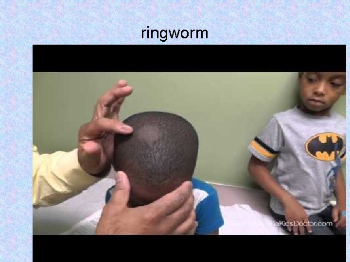 ringworm 43 