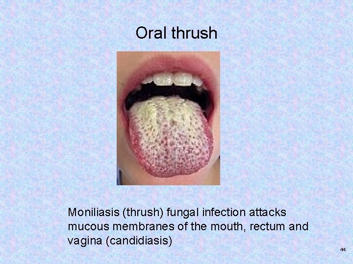 Oral thrush Moniliasis (thrush) fungal infection attacks mucous membranes of the mouth, rectum and