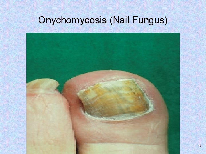 Onychomycosis (Nail Fungus) Copyright © 2017, Elsevier Inc. All rights reserved. 47 