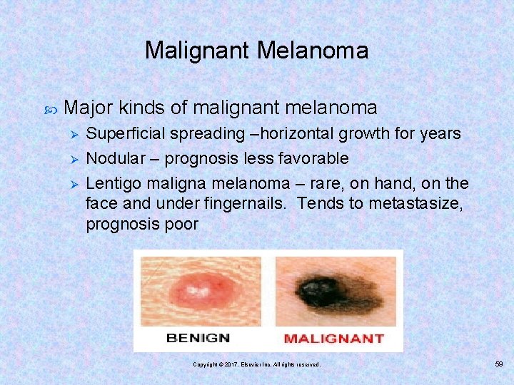 Malignant Melanoma Major kinds of malignant melanoma Ø Ø Ø Superficial spreading –horizontal growth