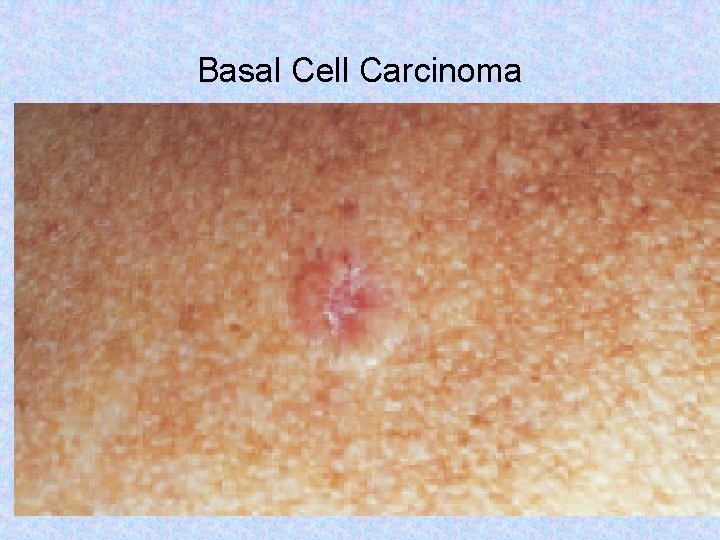 Basal Cell Carcinoma Copyright © 2017, Elsevier Inc. All rights reserved. 61 