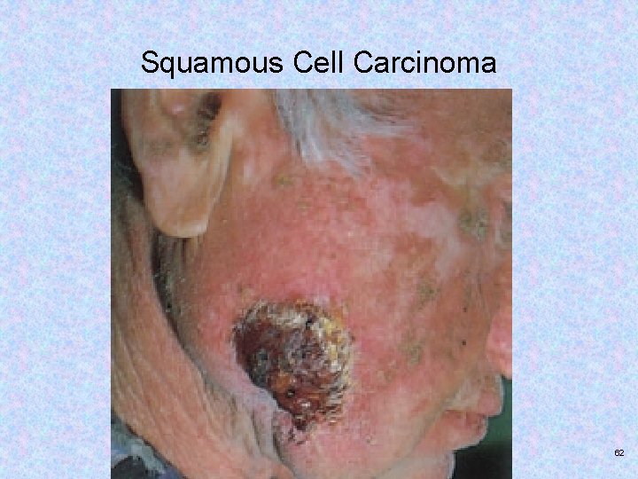 Squamous Cell Carcinoma Copyright © 2017, Elsevier Inc. All rights reserved. 62 