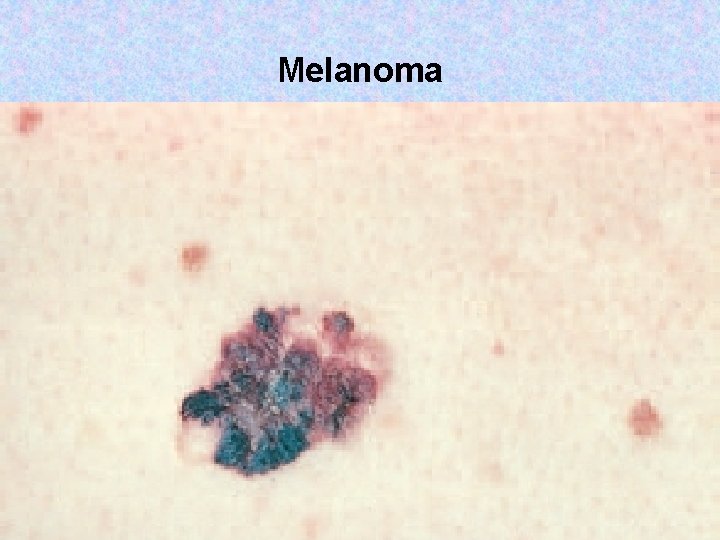 Melanoma Copyright © 2017, Elsevier Inc. All rights reserved. 64 