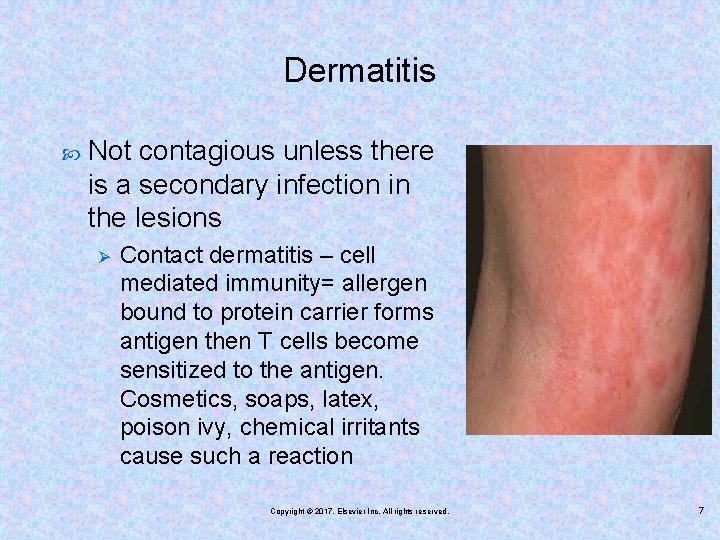 Dermatitis Not contagious unless there is a secondary infection in the lesions Ø Contact