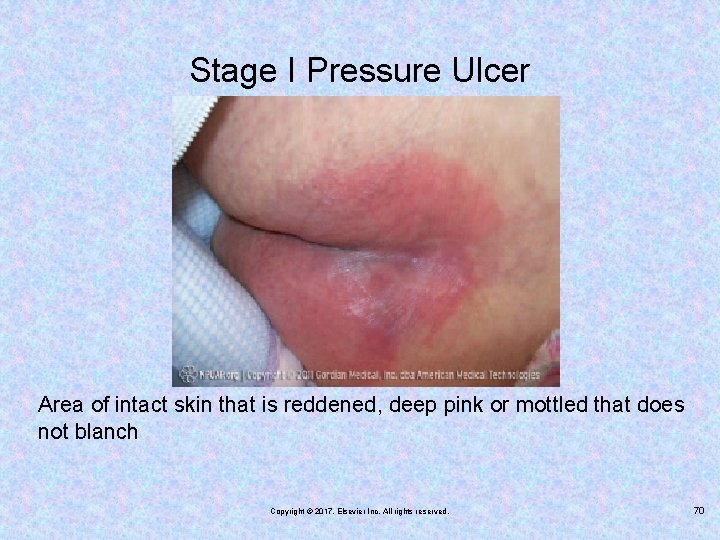 Stage I Pressure Ulcer Area of intact skin that is reddened, deep pink or