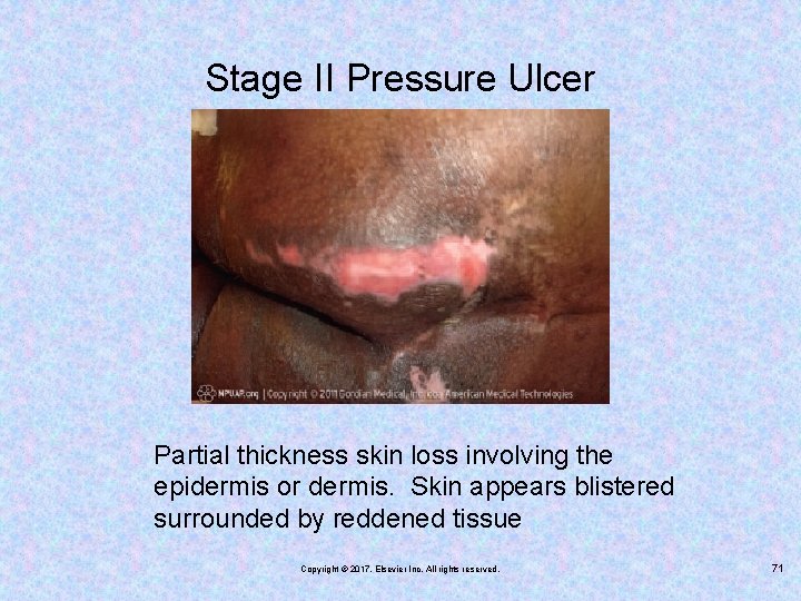 Stage II Pressure Ulcer Partial thickness skin loss involving the epidermis or dermis. Skin