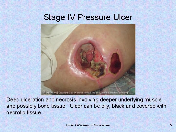 Stage IV Pressure Ulcer Deep ulceration and necrosis involving deeper underlying muscle and possibly