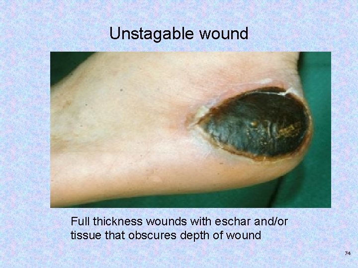 Unstagable wound Full thickness wounds with eschar and/or tissue that obscures depth of wound