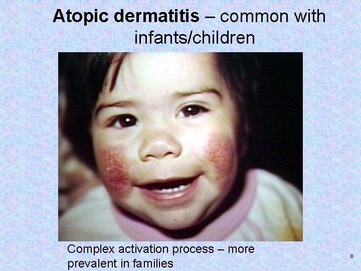Atopic dermatitis – common with infants/children Complex activation process – more prevalent in families