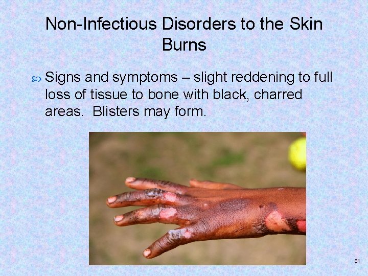 Non-Infectious Disorders to the Skin Burns Signs and symptoms – slight reddening to full