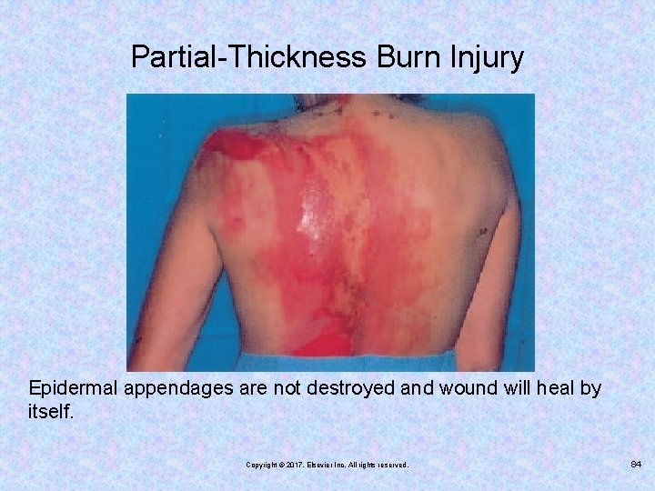 Partial-Thickness Burn Injury Epidermal appendages are not destroyed and wound will heal by itself.