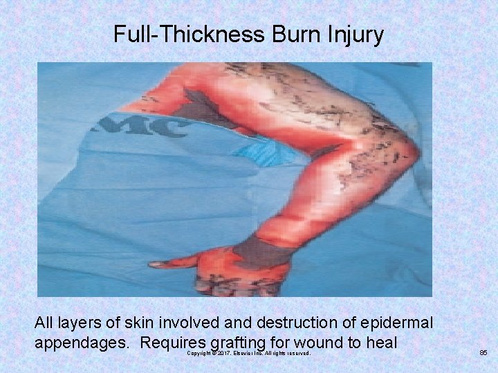 Full-Thickness Burn Injury All layers of skin involved and destruction of epidermal appendages. Requires