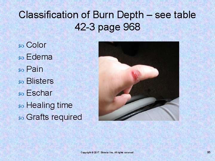 Classification of Burn Depth – see table 42 -3 page 968 Color Edema Pain