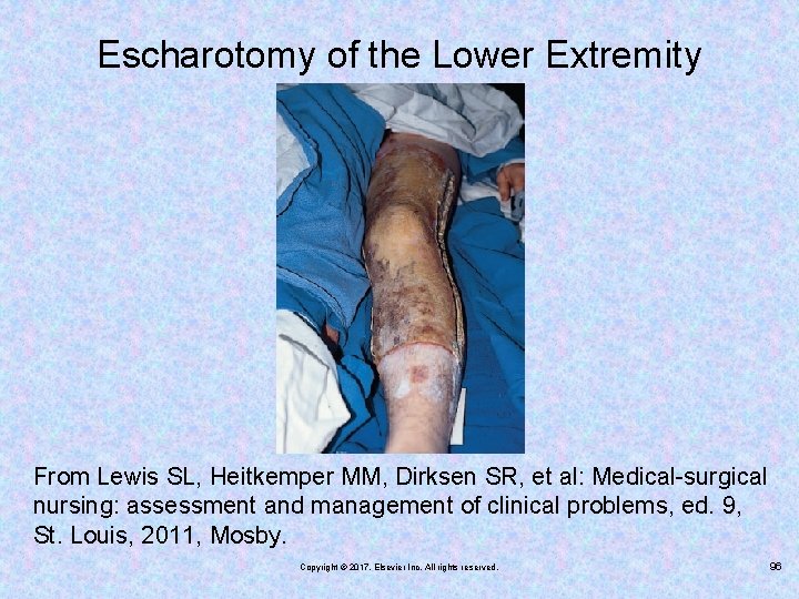 Escharotomy of the Lower Extremity From Lewis SL, Heitkemper MM, Dirksen SR, et al: