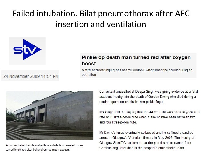 Failed intubation. Bilat pneumothorax after AEC insertion and ventilation 