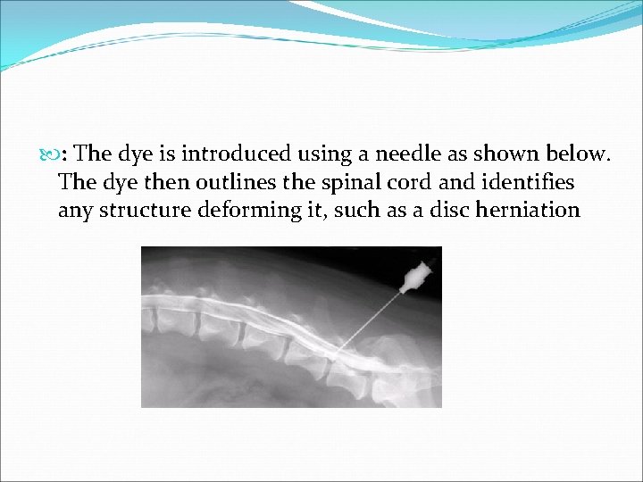  : The dye is introduced using a needle as shown below. The dye