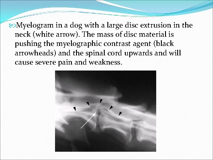  Myelogram in a dog with a large disc extrusion in the neck (white