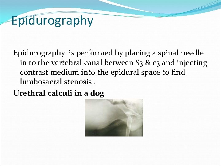 Epidurography is performed by placing a spinal needle in to the vertebral canal between