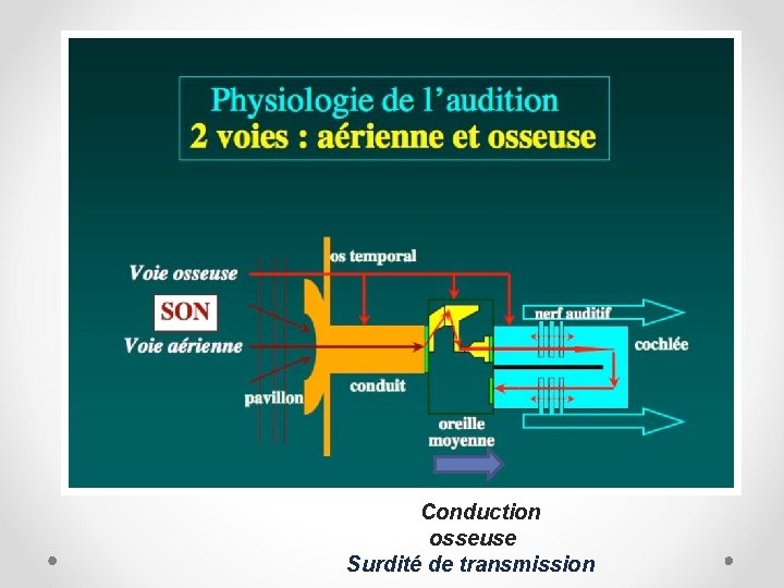 Conduction osseuse Surdité de transmission 